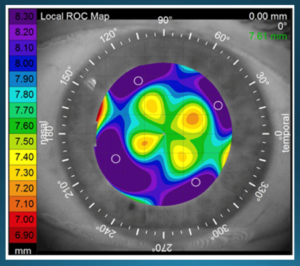 Corneal Topographic