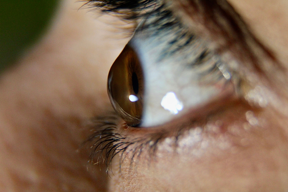 Corneal cross-linking for keratoconus – Toronto, ON